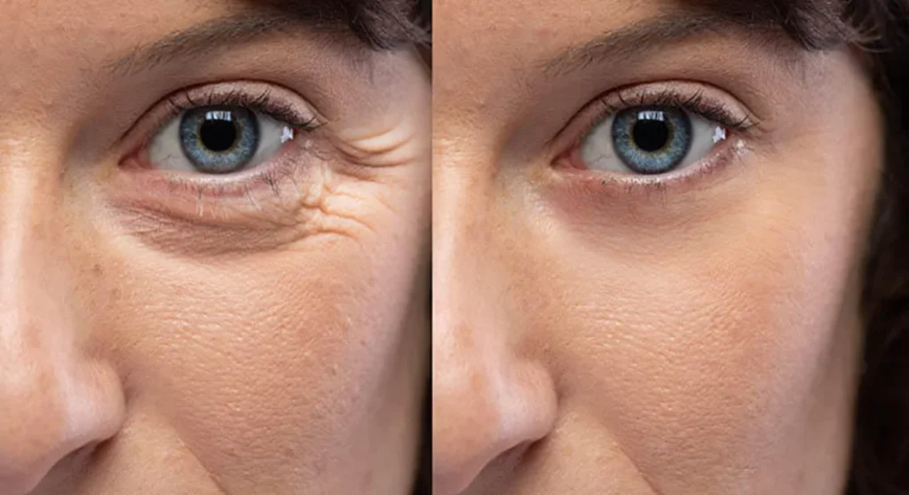 booster injections targeting dark circles