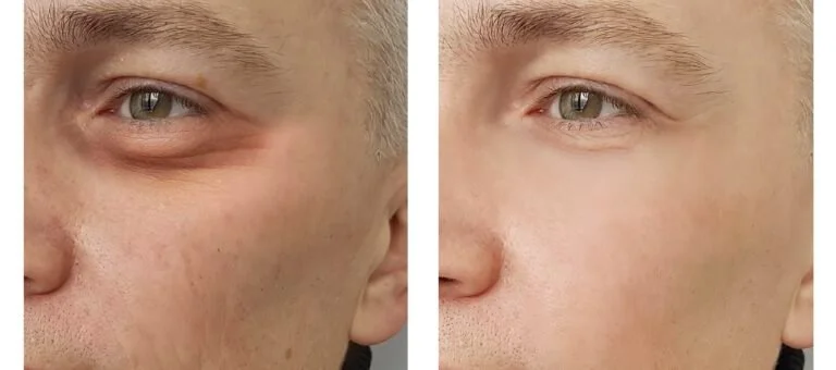skin booster dissolve filler lumps in their tear troughs