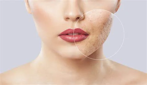 skin boosters to address acne scars and enlarged pores