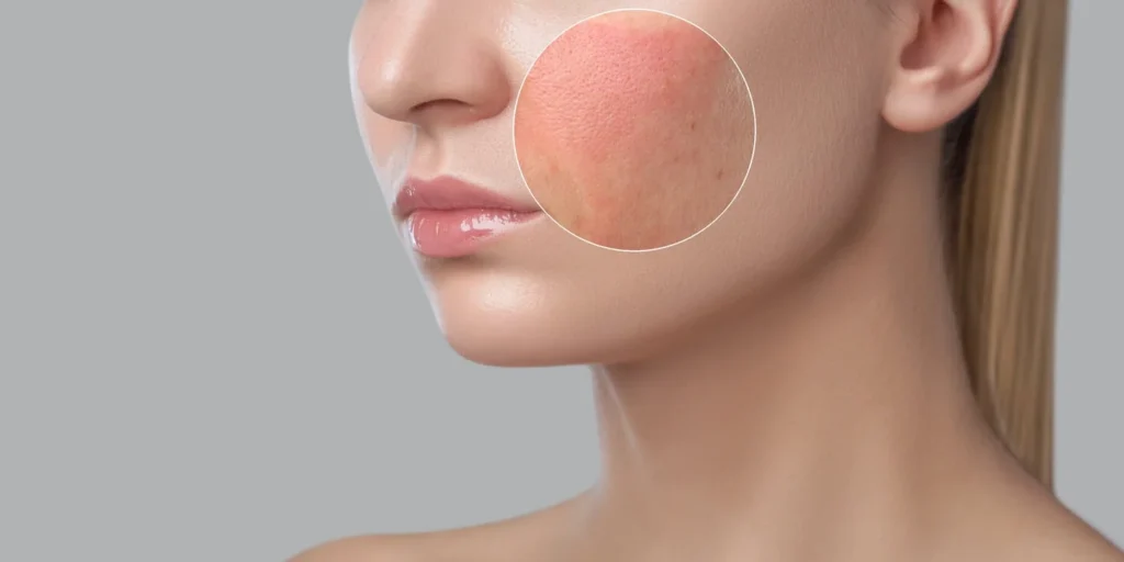 skin-inflammation