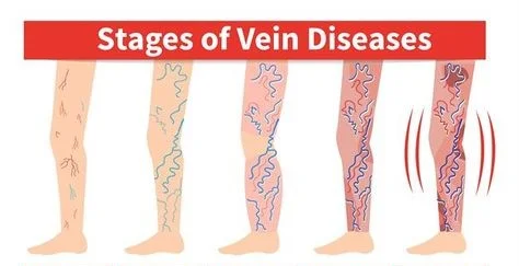Understanding Vein Disease