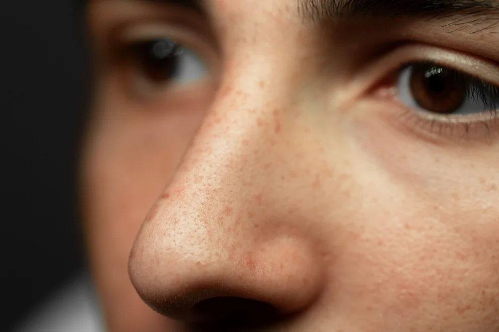 Clogged Pores: Acne And Blackheads