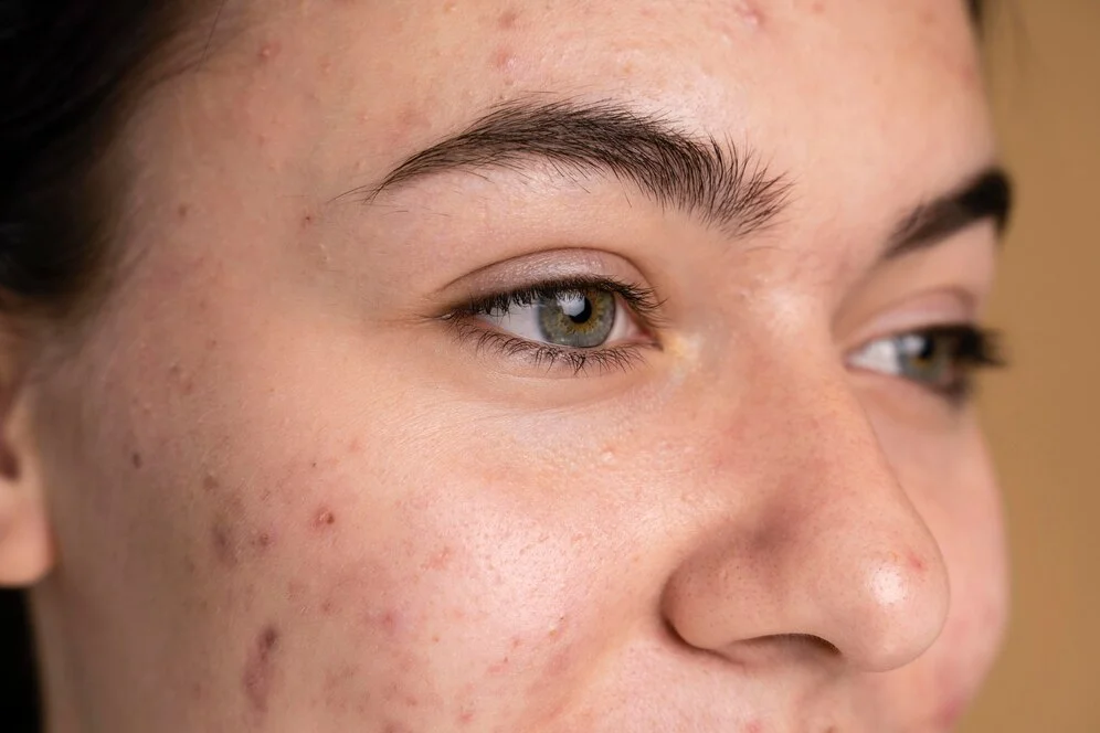 Symptoms of oily skin