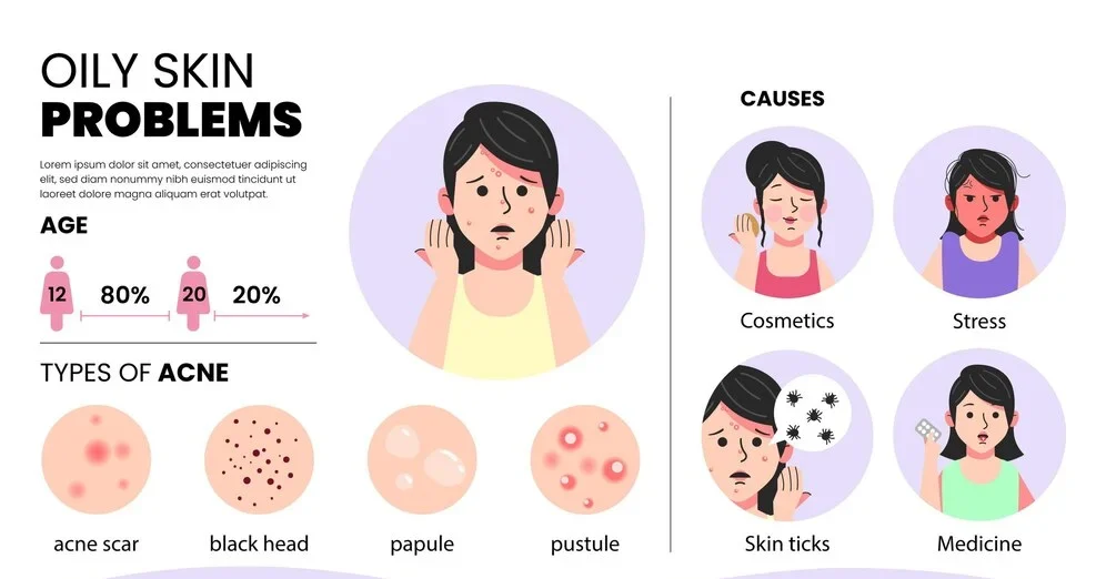 Causes of Oily Skin