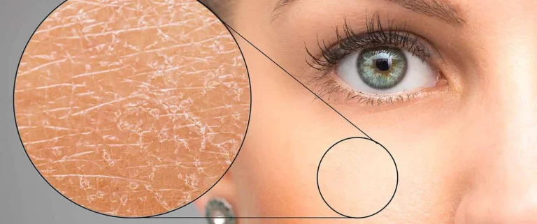 Does Dry Skin Lead to Wrinkles
